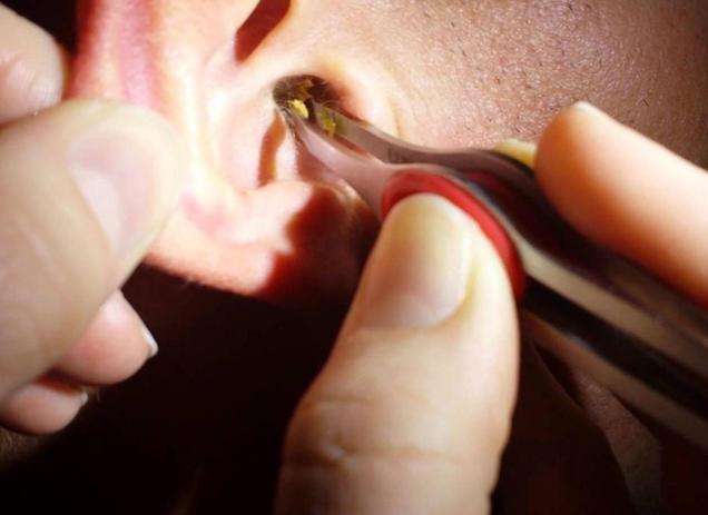 “耳屎”有利于耳朵的健康，潍坊耳鼻喉说