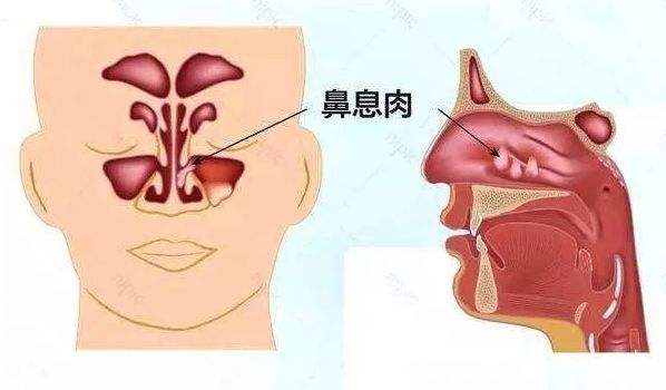 潍坊鼻息肉的预防措施，潍坊耳鼻喉医院